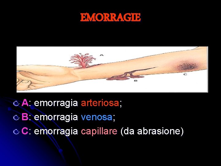 EMORRAGIE A: emorragia arteriosa; B: emorragia venosa; C: emorragia capillare (da abrasione) 