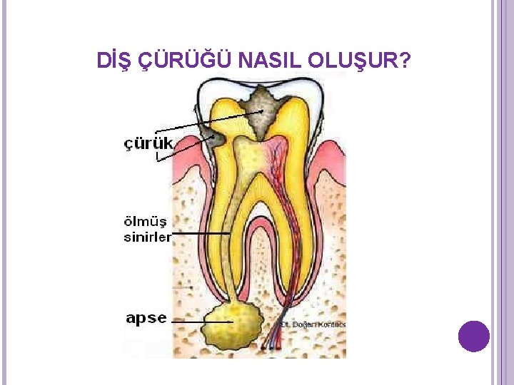 DİŞ ÇÜRÜĞÜ NASIL OLUŞUR? DİŞ ÇÜRÜĞÜ NASIL OLUŞUR?