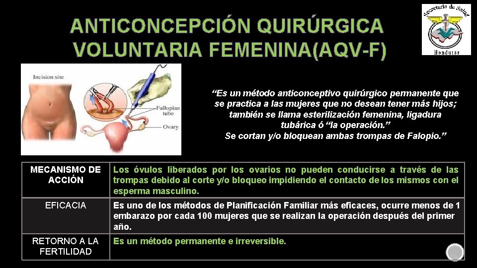 ANTICONCEPCIÓN QUIRÚRGICA VOLUNTARIA FEMENINA(AQV-F) “Es un método anticonceptivo quirúrgico permanente que se practica a