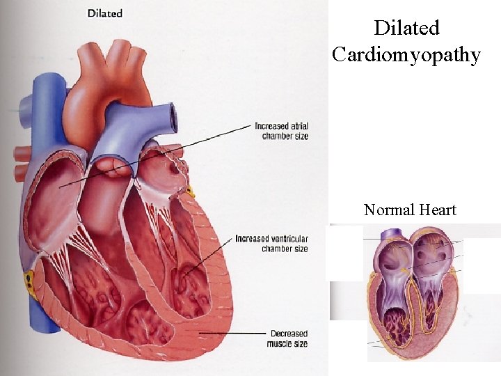 Dilated Cardiomyopathy Normal Heart 