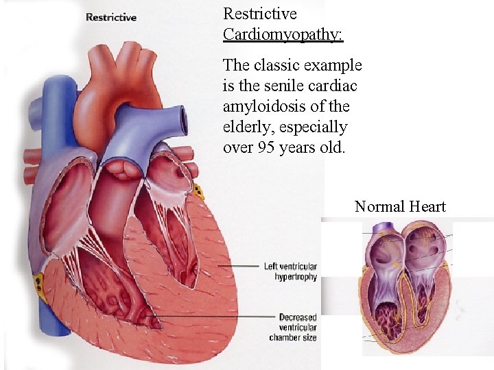 Restrictive Cardiomyopathy: The classic example is the senile cardiac amyloidosis of the elderly, especially