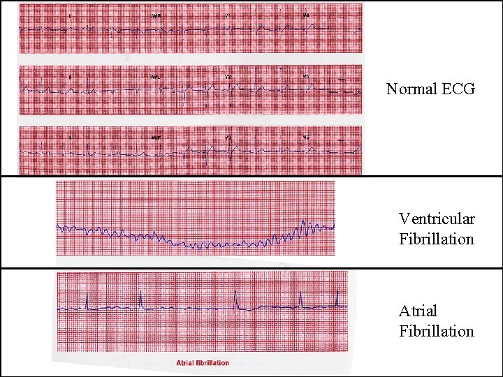 Normal ECG Ventricular Fibrillation Atrial Fibrillation 