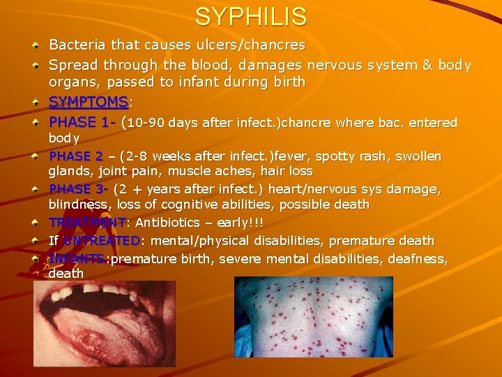 SYPHILIS Bacteria that causes ulcers/chancres Spread through the blood, damages nervous system & body