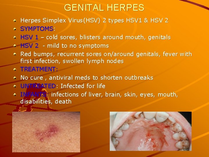 GENITAL HERPES Herpes Simplex Virus(HSV) 2 types HSV 1 & HSV 2 SYMPTOMS: HSV