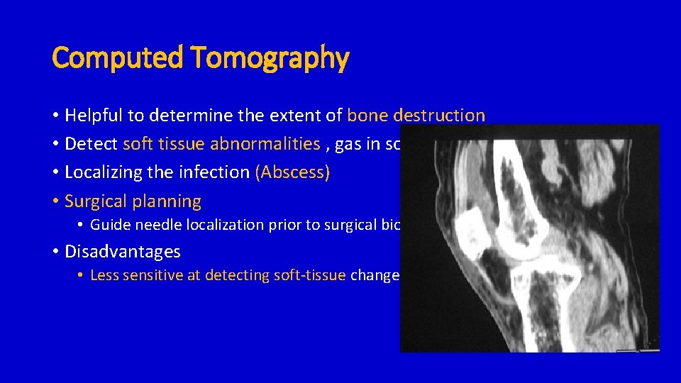 Computed Tomography • Helpful to determine the extent of bone destruction • Detect soft