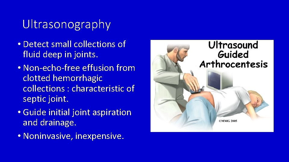 Ultrasonography • Detect small collections of fluid deep in joints. • Non-echo-free effusion from