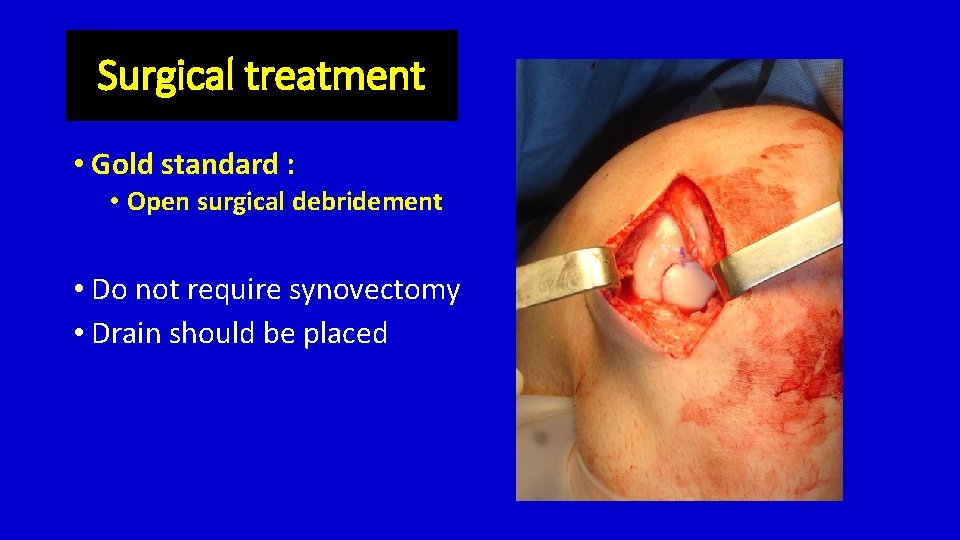 Surgical treatment • Gold standard : • Open surgical debridement • Do not require