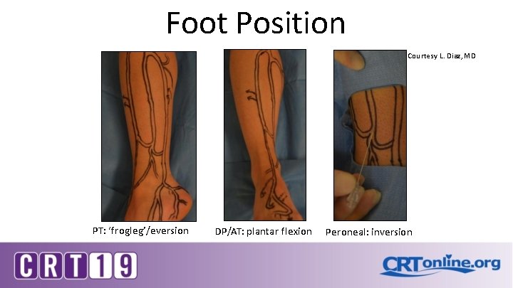 Foot Position Courtesy L. Diaz, MD PT: ‘frogleg’/eversion DP/AT: plantar flexion Peroneal: inversion 