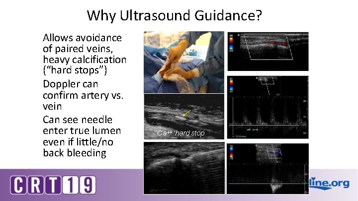 Why Ultrasound Guidance? Allows avoidance of paired veins, heavy calcification (“hard stops”) Doppler can