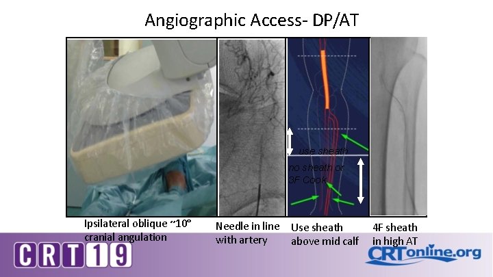 Angiographic Access- DP/AT use sheath no sheath or 3 F Cook Ipsilateral oblique ~10°