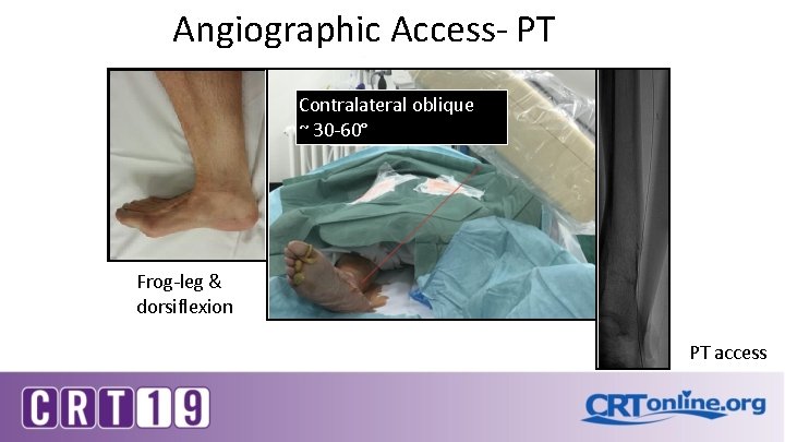 Angiographic Access- PT Contralateral oblique ~ 30 -60° Frog-leg & dorsiflexion PT access 