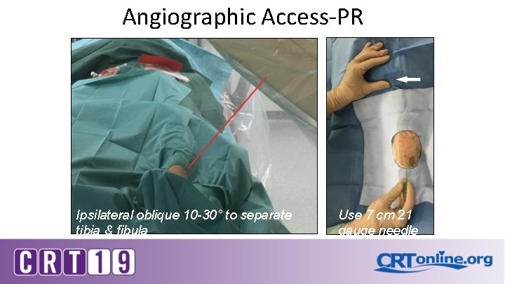 Angiographic Access-PR Ipsilateral oblique 10 -30° to separate tibia & fibula Use 7 cm