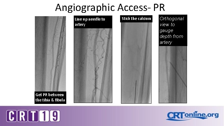 Angiographic Access- PR Line up needle to artery Get PR between the tibia &