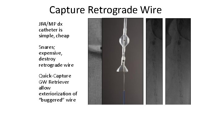 Capture Retrograde Wire JR 4/MP dx catheter is simple, cheap Snares; expensive, destroy retrograde