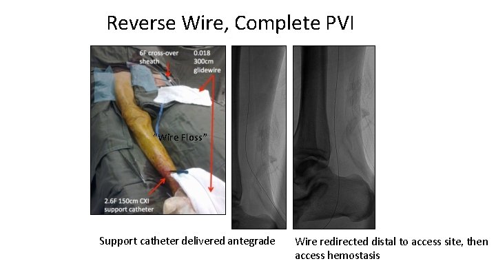 Reverse Wire, Complete PVI “Wire Floss” Support catheter delivered antegrade Wire redirected distal to