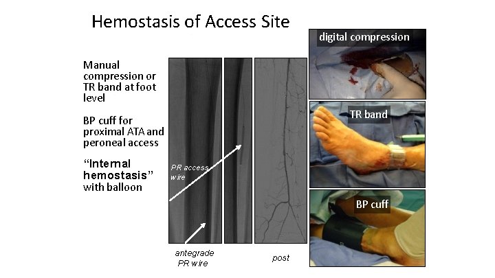 Hemostasis of Access Site digital compression Manual compression or TR band at foot level
