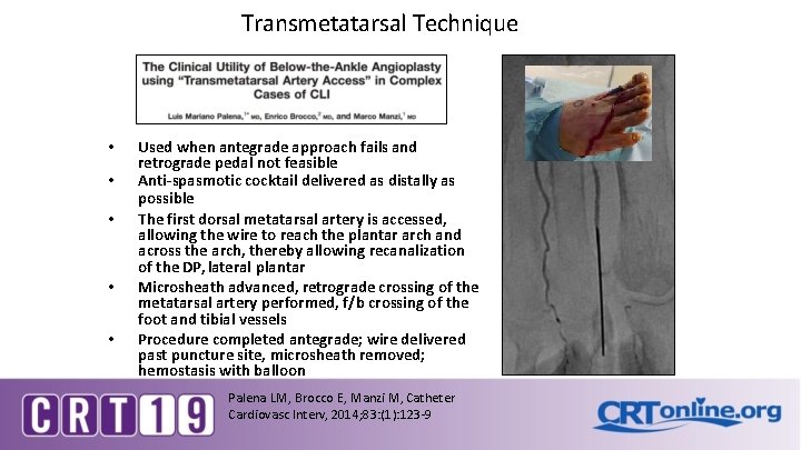 Transmetatarsal Technique • • • Used when antegrade approach fails and retrograde pedal not