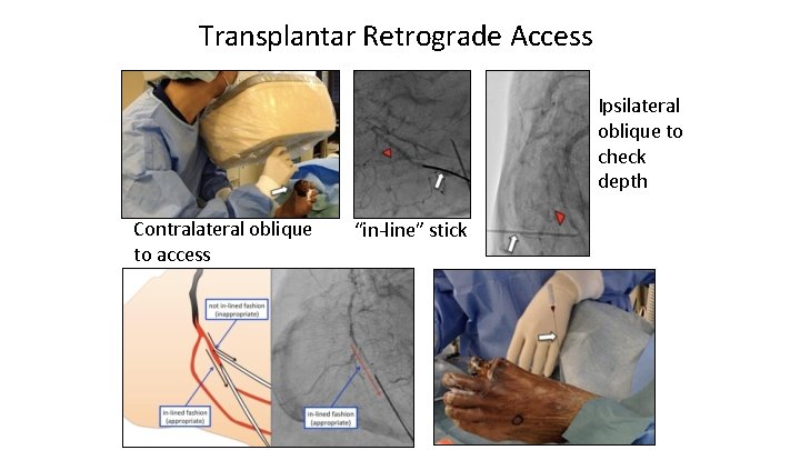 Transplantar Retrograde Access Ipsilateral oblique to check depth Contralateral oblique to access “in-line” stick