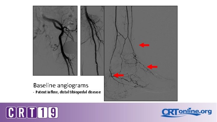 Baseline angiograms - Patent inflow, distal tibiopedal disease 