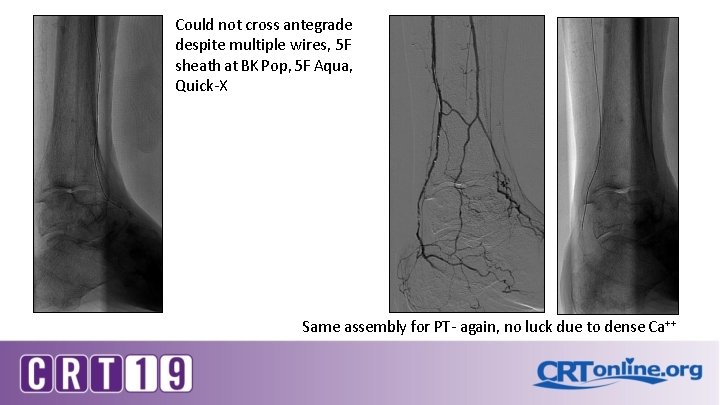 Could not cross antegrade despite multiple wires, 5 F sheath at BK Pop, 5