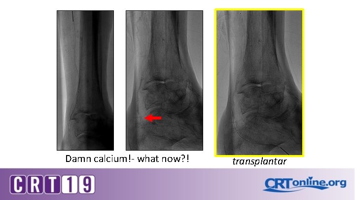 Damn calcium!- what now? ! transplantar 