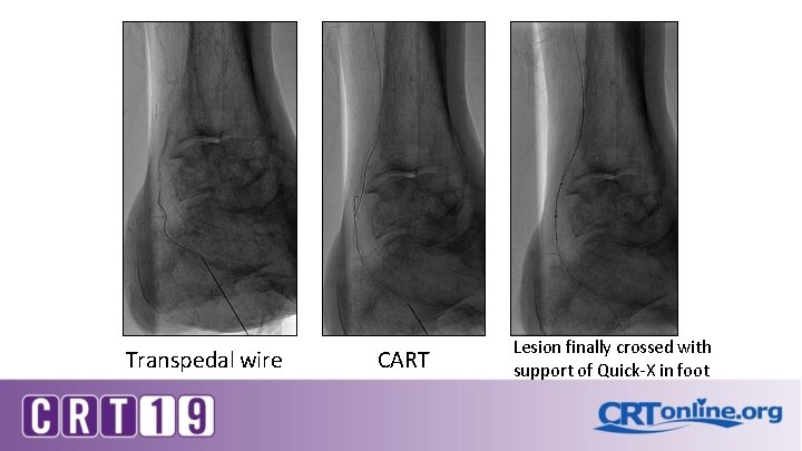 Transpedal wire CART Lesion finally crossed with support of Quick-X in foot 