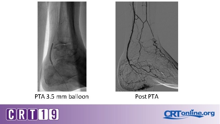 PTA 3. 5 mm balloon Post PTA 