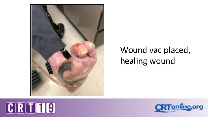 Wound vac placed, healing wound 