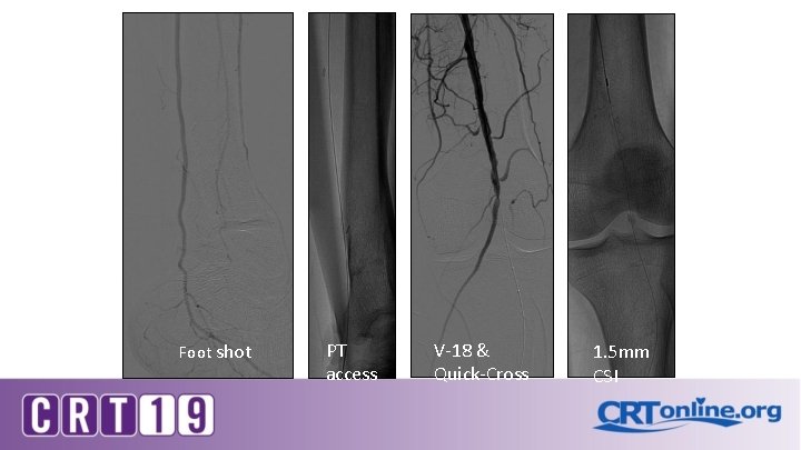 Foot shot PT access V-18 & Quick-Cross 1. 5 mm CSI 