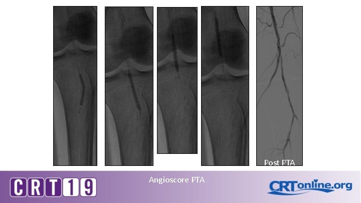 Post PTA Angioscore PTA 