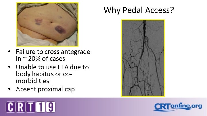 Why Pedal Access? • Failure to cross antegrade in ~ 20% of cases •