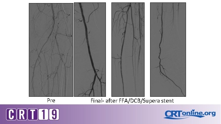 Pre Final- after FFA/DCB/Supera stent 