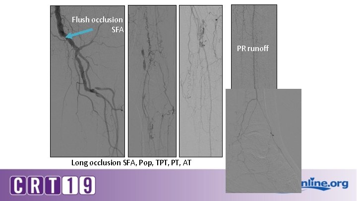 Flush occlusion SFA PR runoff Long occlusion SFA, Pop, TPT, AT 