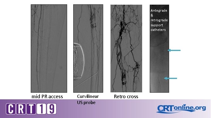 Antegrade & retrograde support catheters mid PR access Curvilinear US probe Retro cross 