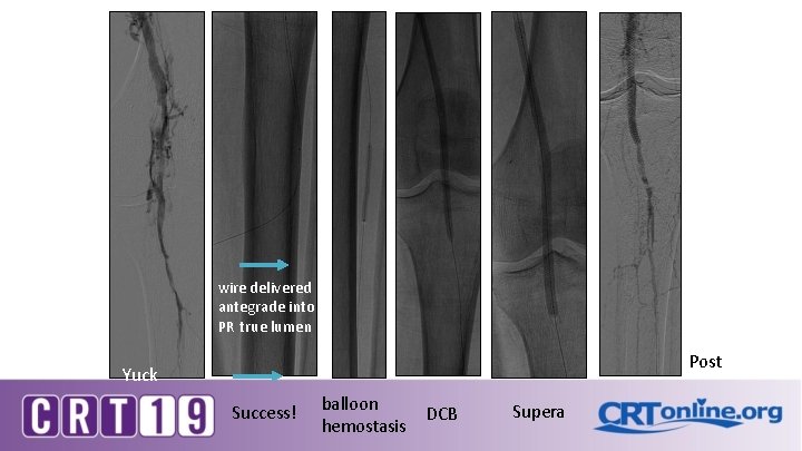 wire delivered antegrade into PR true lumen Post Yuck Success! balloon hemostasis DCB Supera