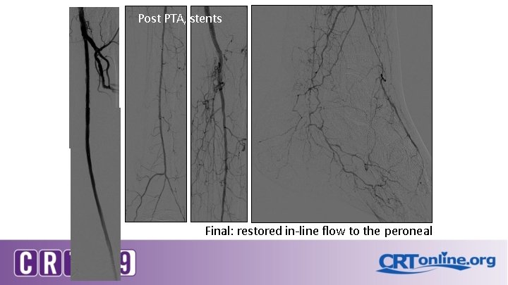 Post PTA, stents Final: restored in-line flow to the peroneal 