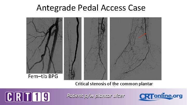 Antegrade Pedal Access Case Fem–tib BPG Critical stenosis of the common plantar Patient p/w