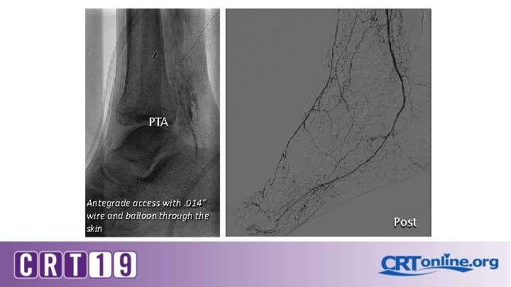 PTA Antegrade access with. 014” wire and balloon through the skin Post 