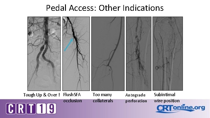 Pedal Access: Other Indications Tough Up & Over ! Flush SFA occlusion Too many