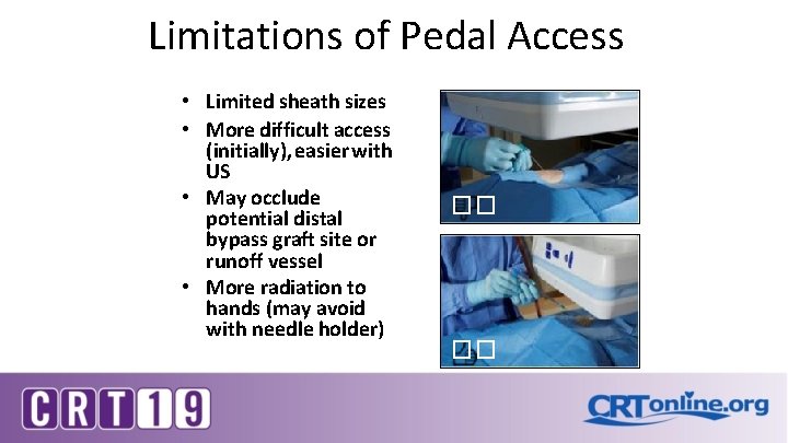 Limitations of Pedal Access • Limited sheath sizes • More difficult access (initially), easier