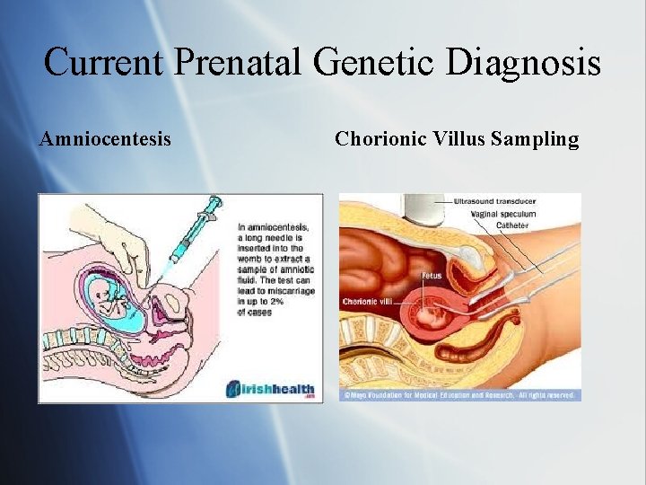 Current Prenatal Genetic Diagnosis Amniocentesis Chorionic Villus Sampling 