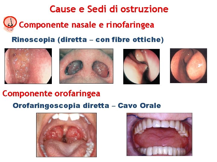 Cause e Sedi di ostruzione Componente nasale e rinofaringea Rinoscopia (diretta – con fibre