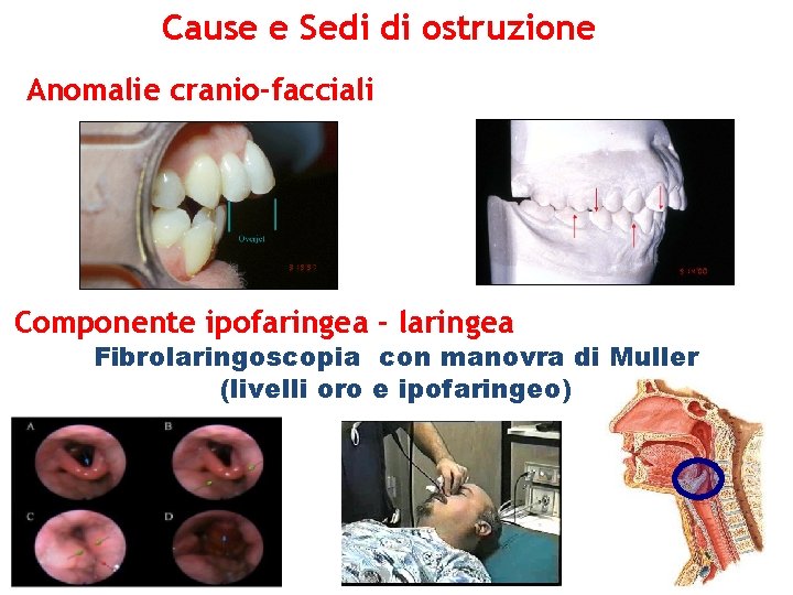 Cause e Sedi di ostruzione Anomalie cranio-facciali Componente ipofaringea - laringea Fibrolaringoscopia con manovra