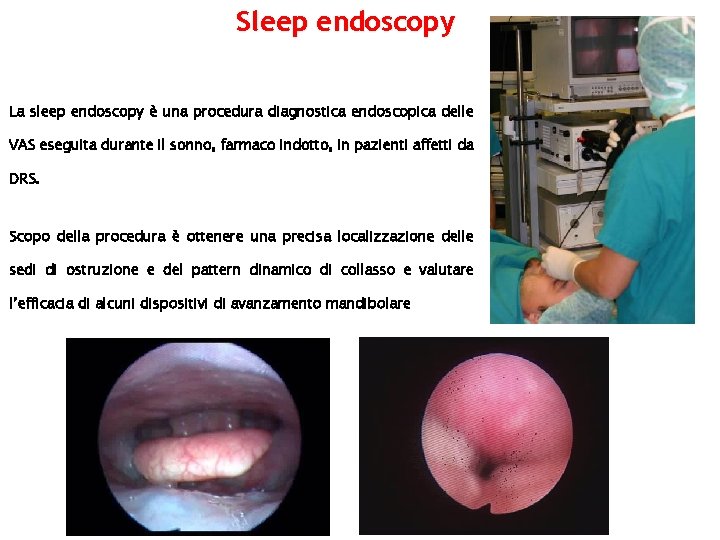 Sleep endoscopy La sleep endoscopy è una procedura diagnostica endoscopica delle VAS eseguita durante