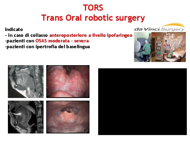TORS Trans Oral robotic surgery Indicato - in caso di collasso anteroposteriore a livello