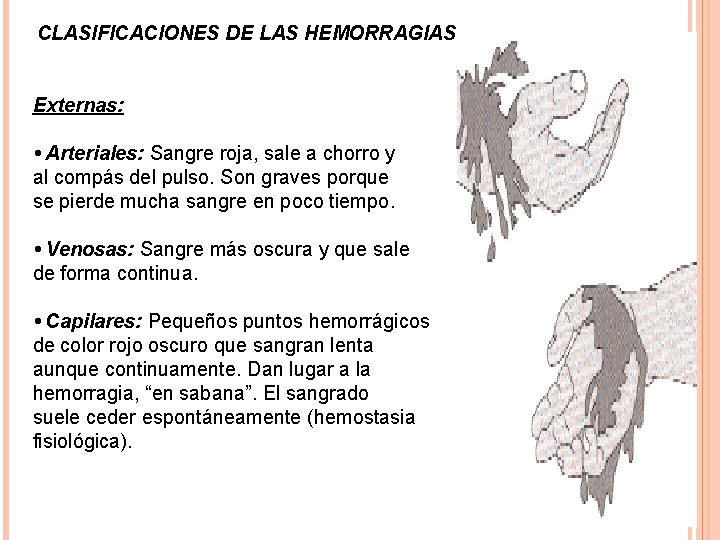 CLASIFICACIONES DE LAS HEMORRAGIAS Externas: • Arteriales: Sangre roja, sale a chorro y al