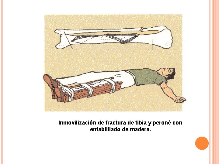 Inmovilización de fractura de tibia y peroné con entablillado de madera. 