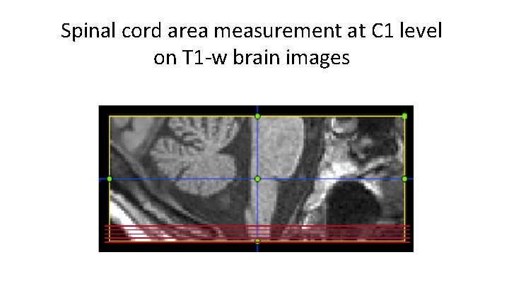 Spinal cord area measurement at C 1 level on T 1 -w brain images
