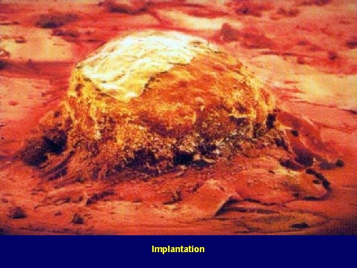 Implantation 