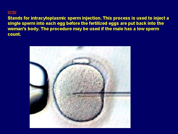ICSI Stands for intracytoplasmic sperm injection. This process is used to inject a single